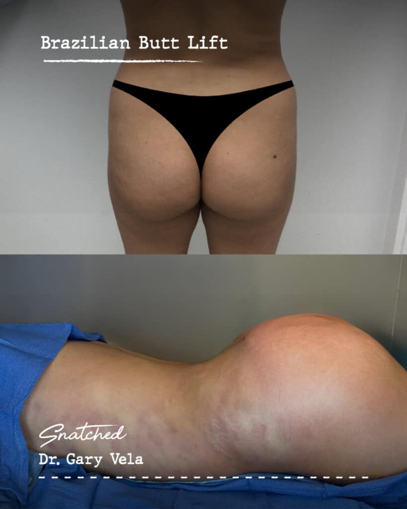 Before and after Brazilian Butt Lift procedure.