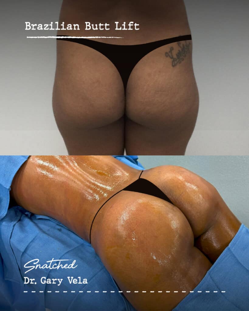 Before and after Brazilian Butt Lift results.