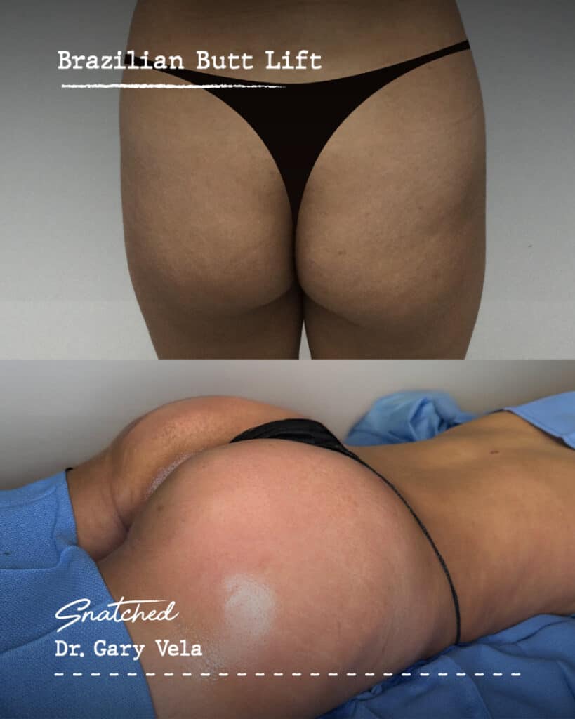 Brazilian Butt Lift results comparison photo.