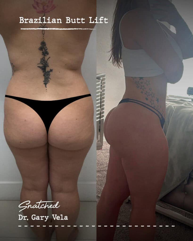 Brazilian butt lift before and after photos