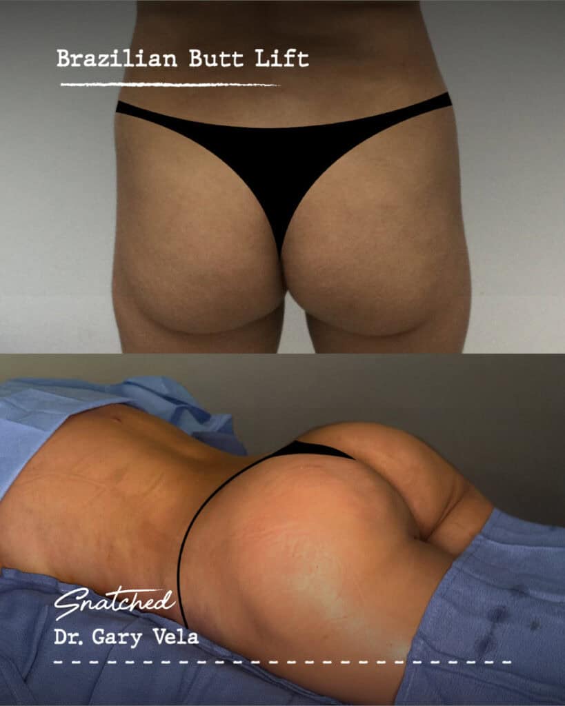 Brazilian Butt Lift surgery results before and after.