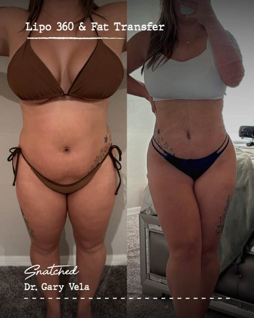 Before and after Lipo 360 fat transfer results.
