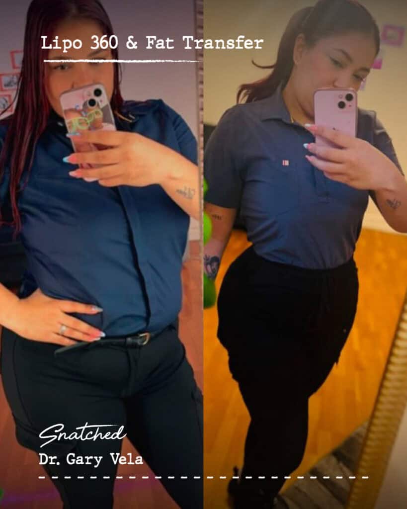 Woman's transformation: Lipo 360 and fat transfer results.