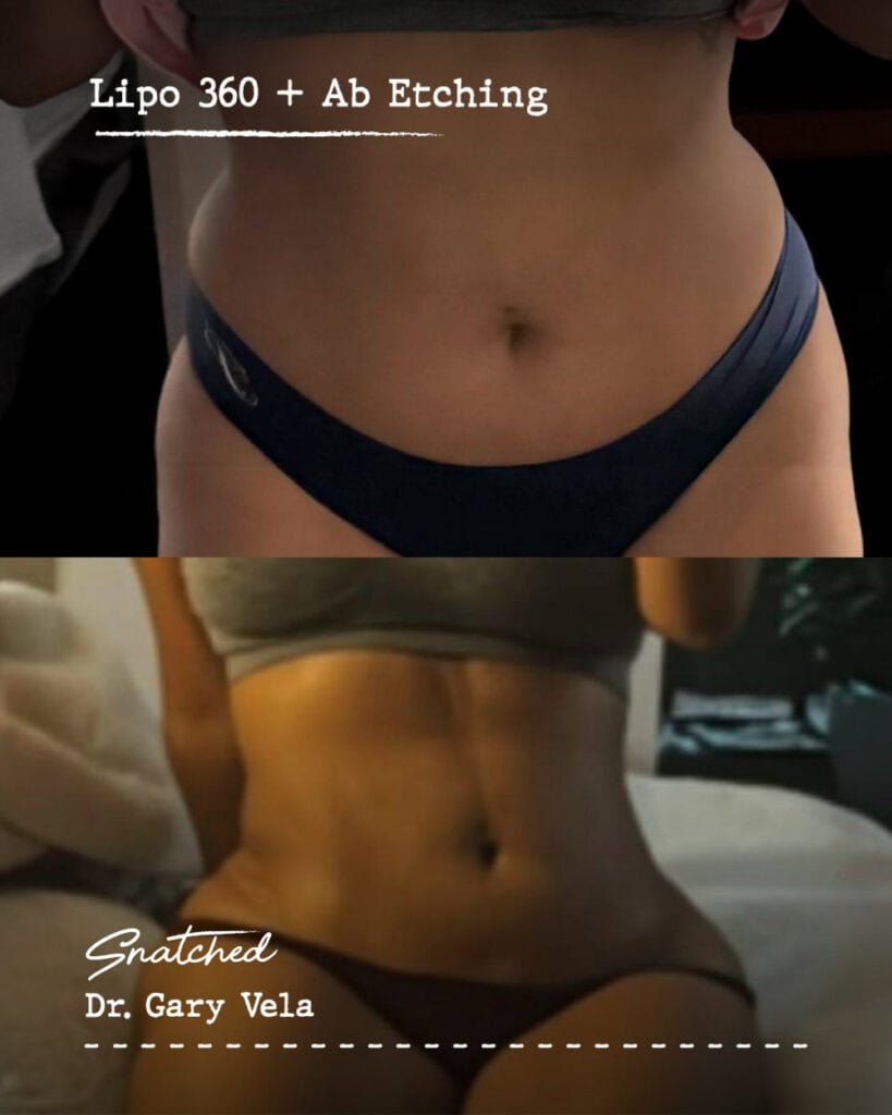 Before and after lipo 360, ab etching results