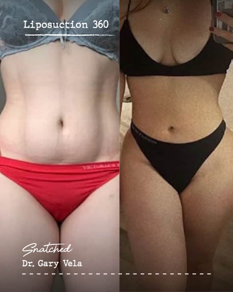 Before and after liposuction transformation photo.