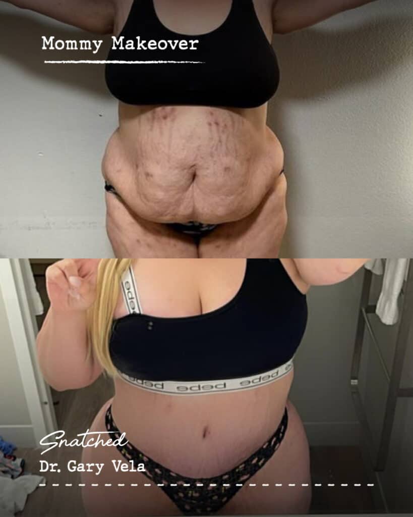 Before and after Mommy Makeover results.