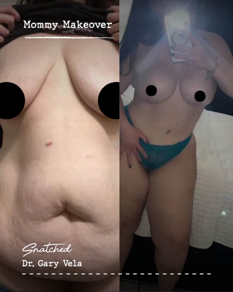 Before and after mommy makeover transformation