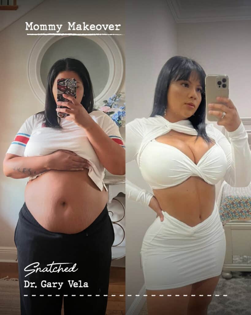 Mommy Makeover before and after photos