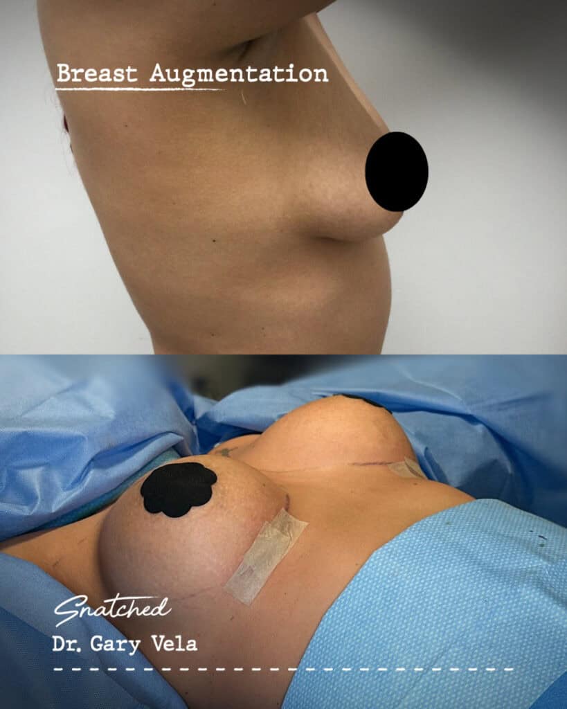 Breast augmentation before and after surgery images.