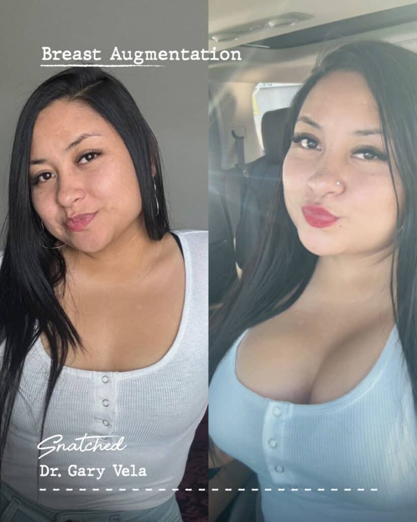 Before and after breast augmentation results.