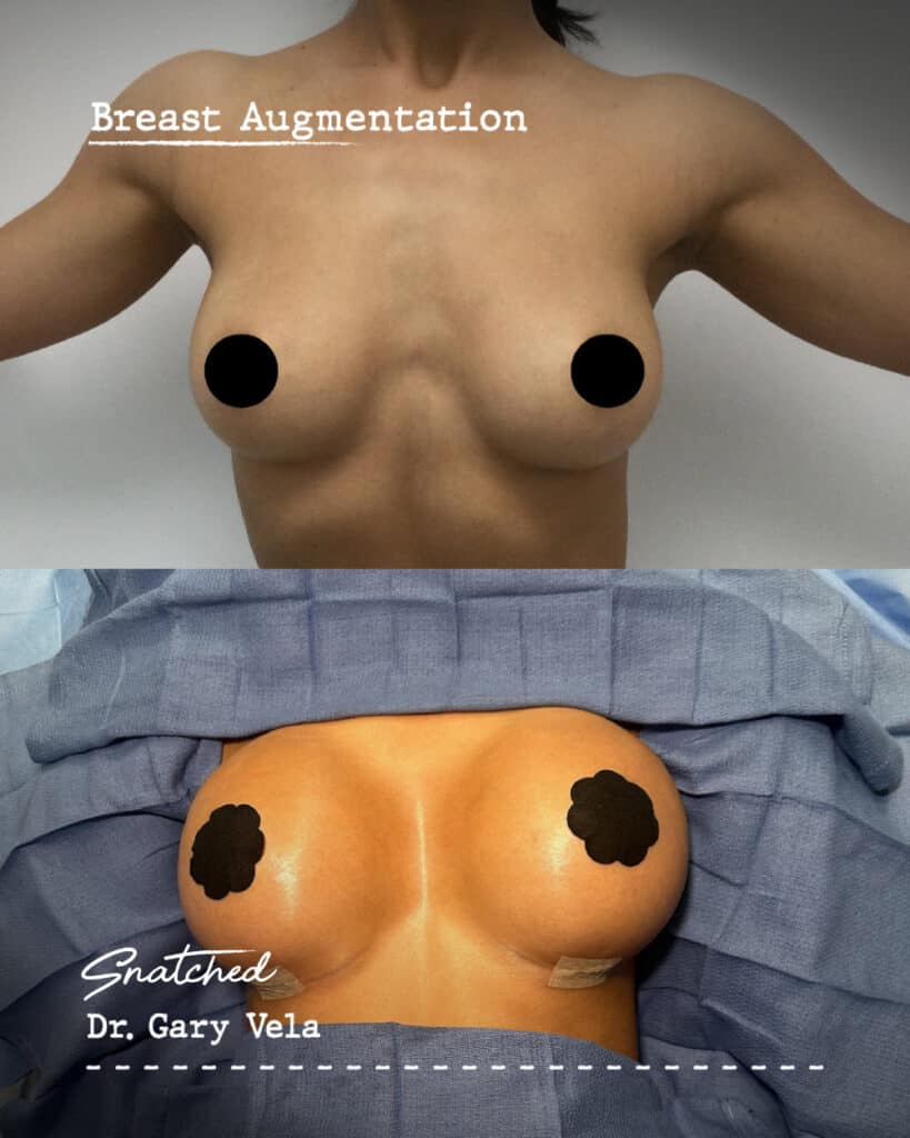 Before and after breast augmentation results.