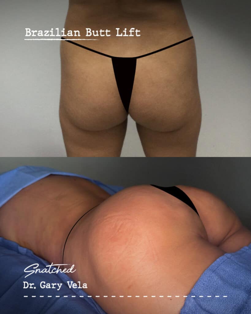 Brazilian Butt Lift before and after comparison