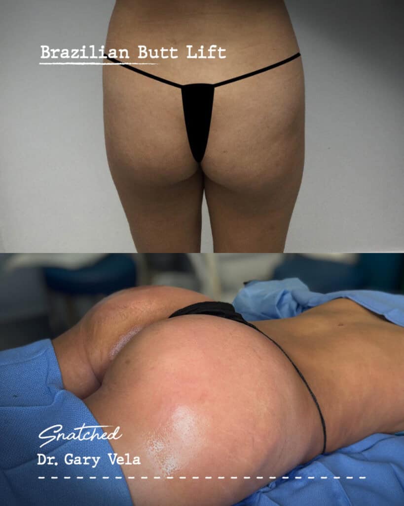 Brazilian Butt Lift before and after results