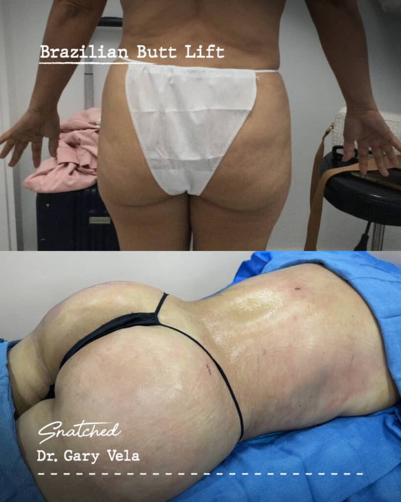 Brazilian butt lift before and after results