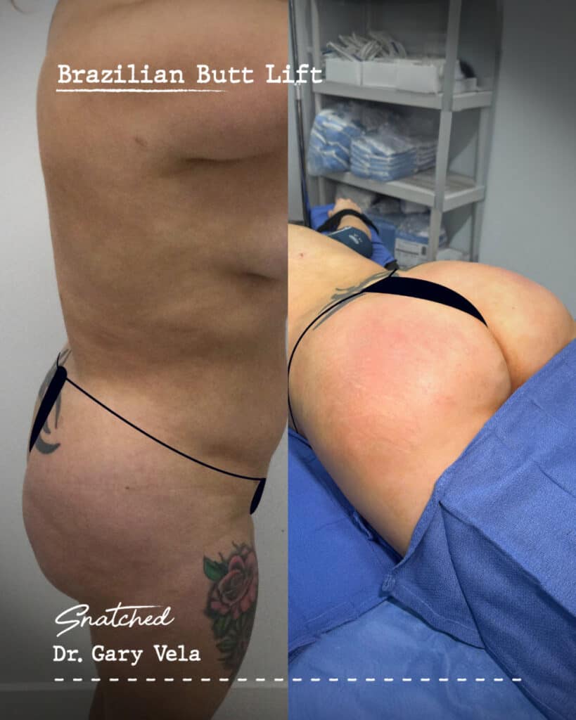 Brazilian Butt Lift before and after results.