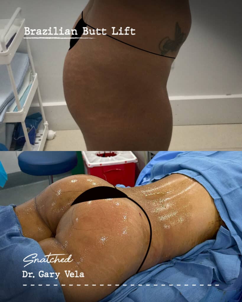 Brazilian butt lift surgery results, before and after.