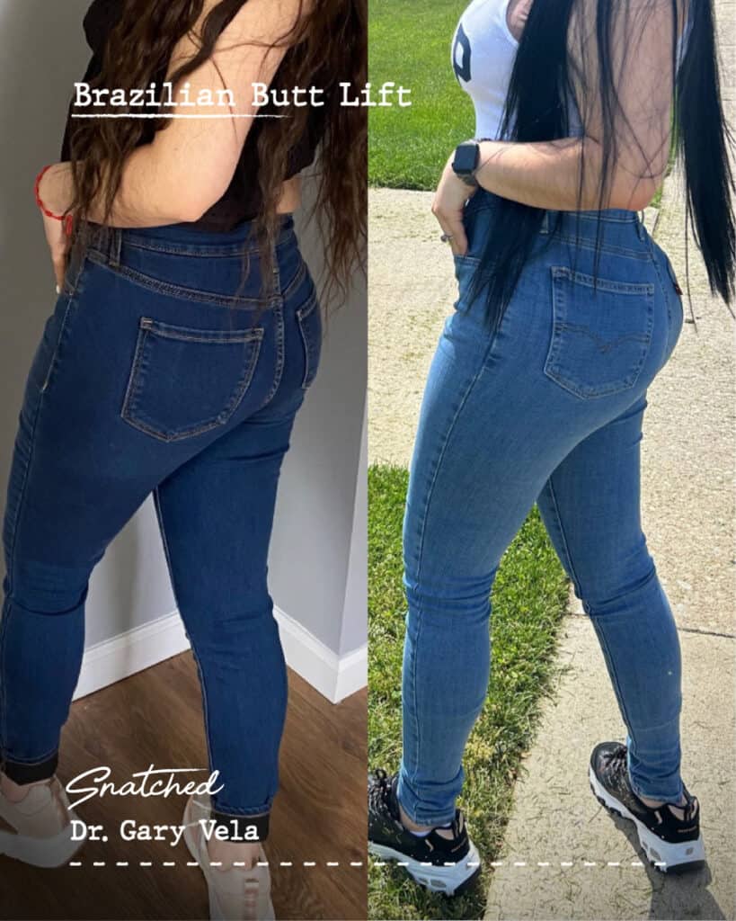 Brazilian Butt Lift transformation before and after photos.