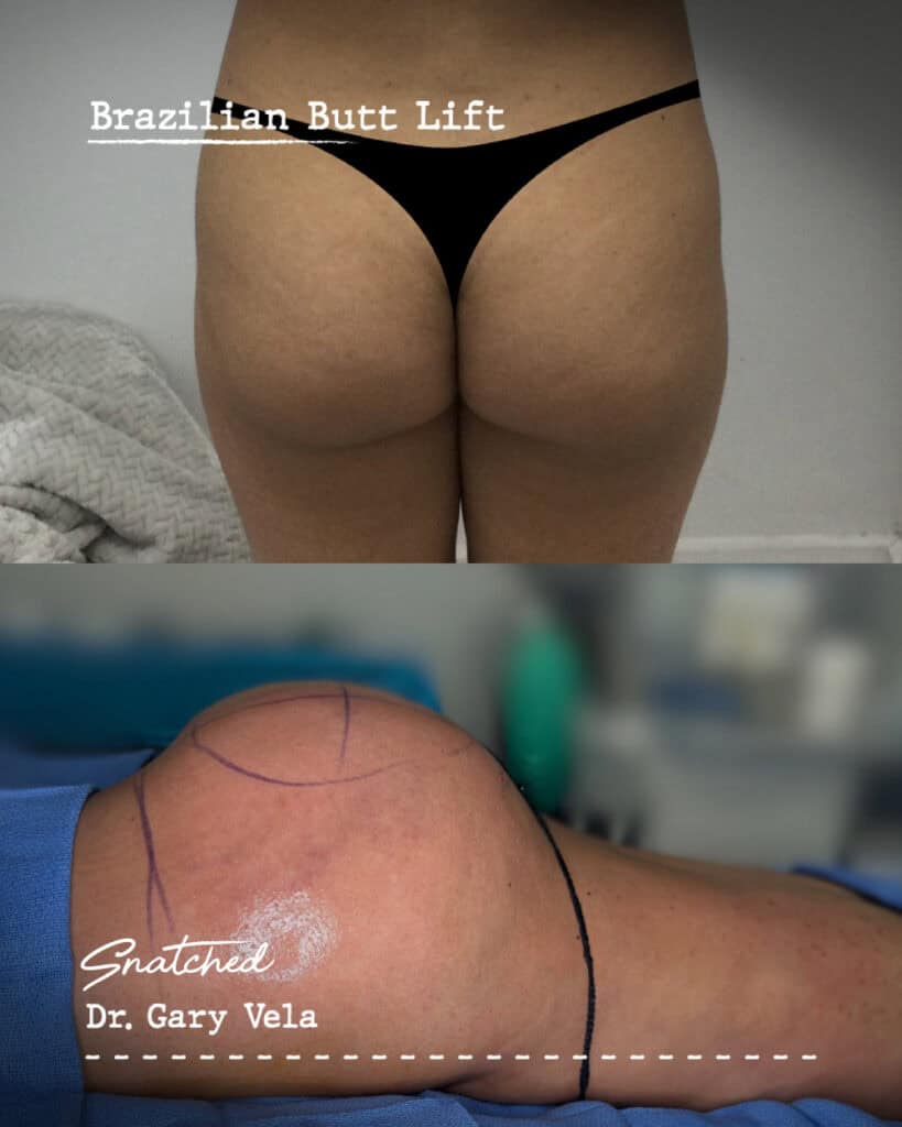 Before and after Brazilian Butt Lift procedure