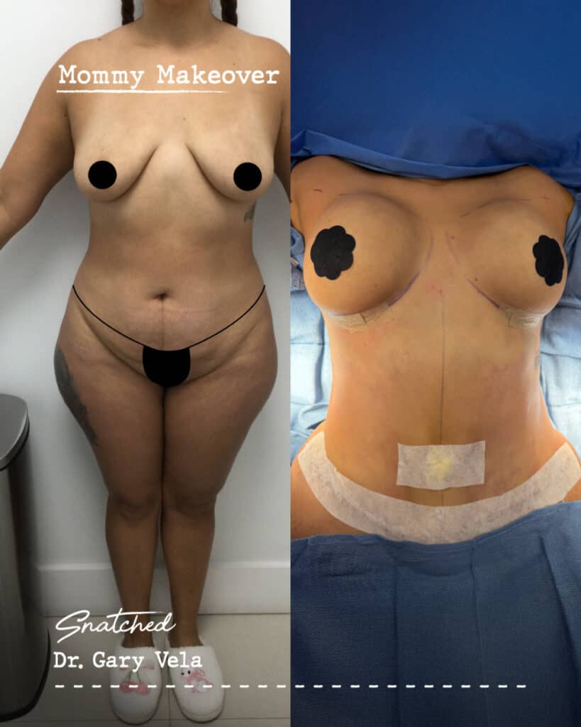 Before and after mommy makeover surgery results.